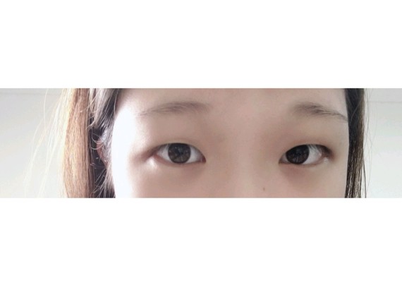 肿眼泡怎么做双眼皮?切开双眼皮手术是在上眼