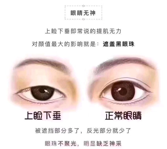 深圳晨曦科普#什么是上睑下垂?
