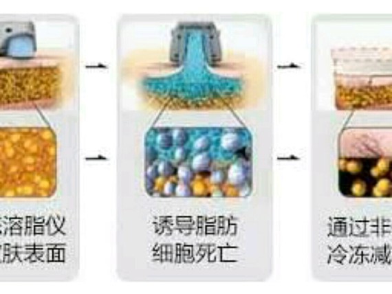 今天来聊聊酷塑冷冻溶脂吧97首先酷塑冷冻溶脂原理是通_圈子-新氧