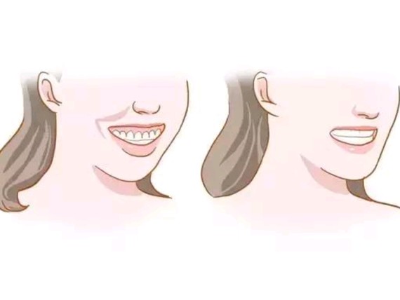 01龅牙(牙齿前突)牙齿前突的现象在中国人中算