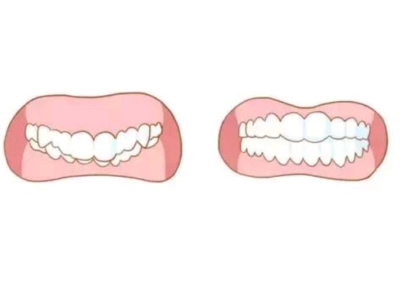 01龅牙(牙齿前突)牙齿前突的现象在中国人中算