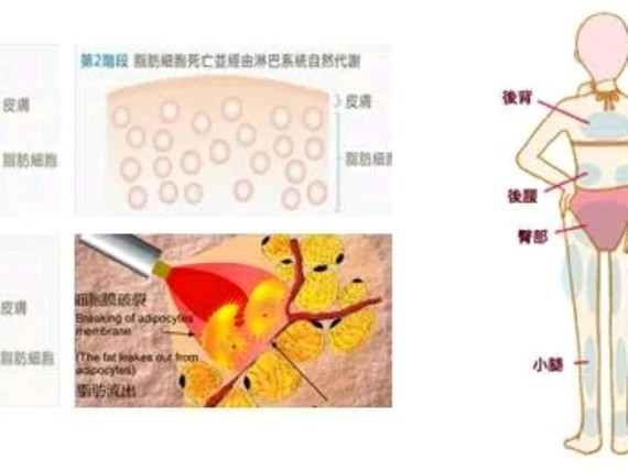 新氧-张涛|轮廓面部|胸部|美体塑形|瘦脸|广州同城|吸脂瘦身汤最快见效图片