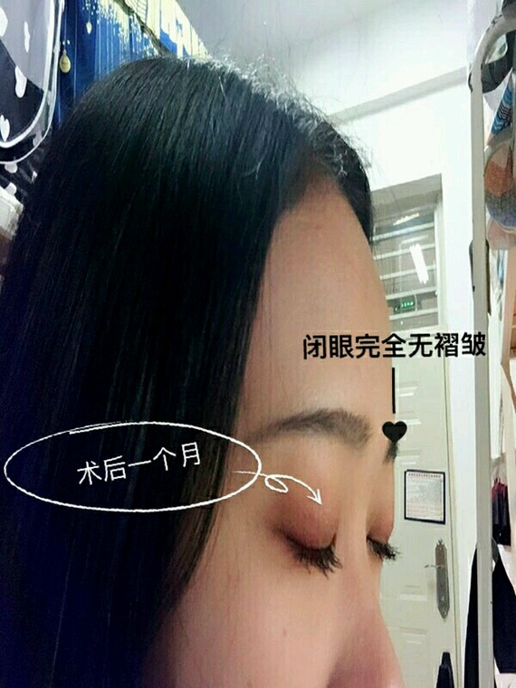 双眼皮术后多层褶皱怎么处理?