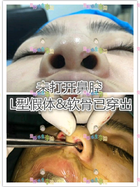 比如:假体由于重力下滑引起的鼻筋下旋,鼻假体太高引起的发红,皮肤