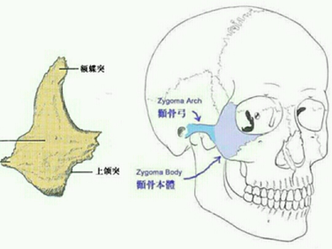 颧骨整形加减术颧骨凸出怎么办