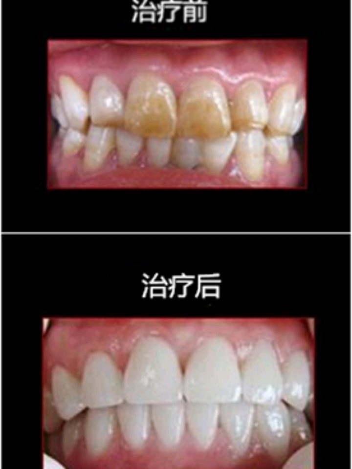 科普# 重度氟斑牙该怎么治疗?