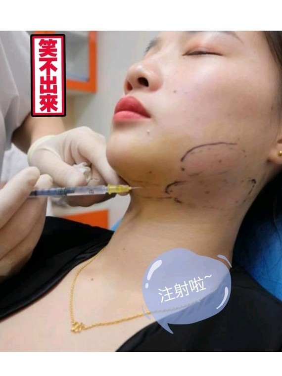 肉肉脸妹纸的瘦脸神器减脂针初v瘦脸减脂椰子汁图片