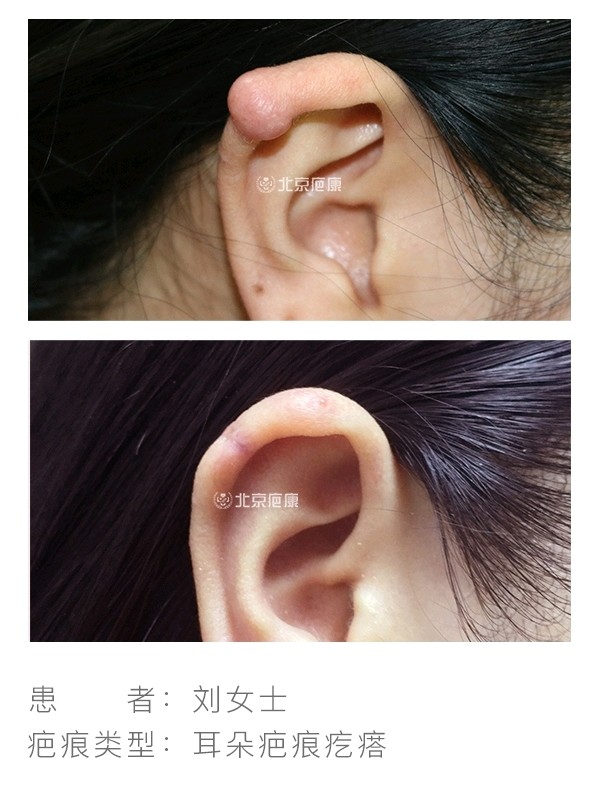 【耳朵疤痕疙瘩病例分享】刘女士喜欢穿孔洞,左耳打了七个,右耳打了四