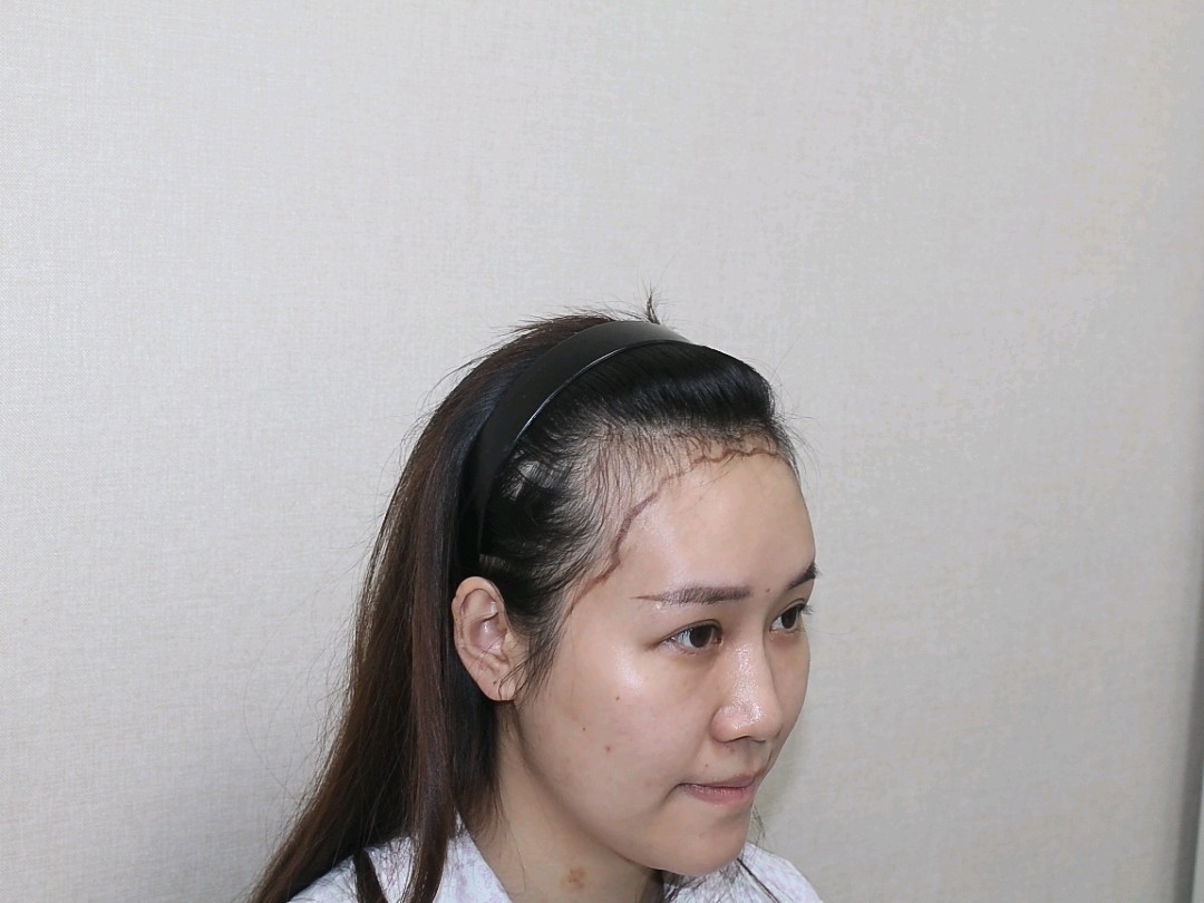 植发必看:发际线美学盘点不同脸型适合的发际线形状