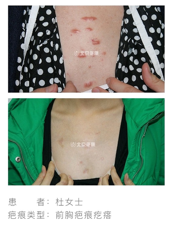 为求诊治,2014年3月15日来到北京疤康就诊,瘢痕主治医生刘加勇为杜