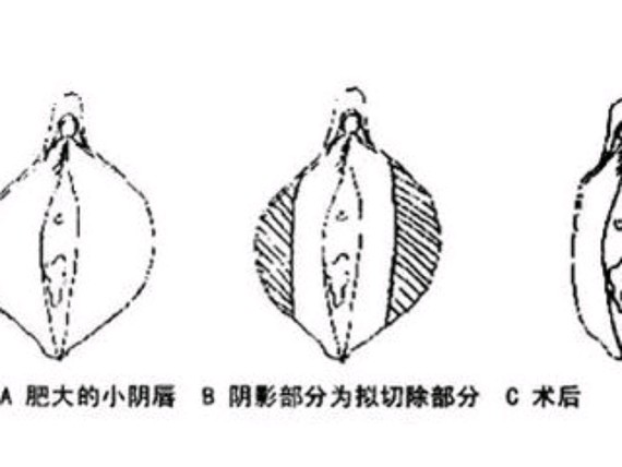 这种女性一般日常生活都会感到十分痛苦,走路时的摩擦更是疼痛难忍,就