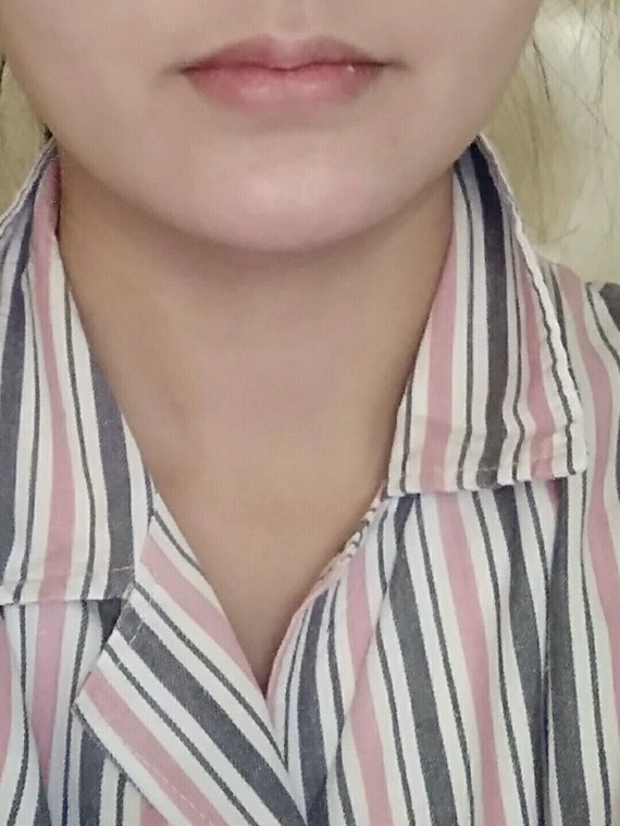 做完磨骨手术第四天了,嘴巴肿成这样,还翻得狠