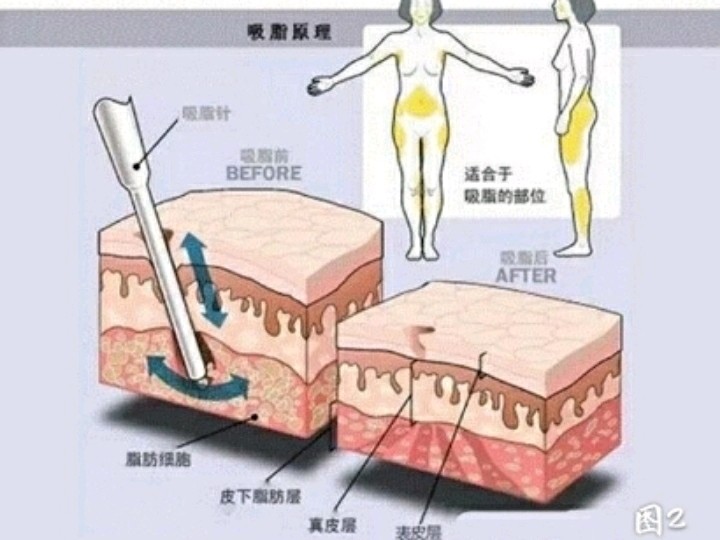 面部吸脂多久消肿?怎样可以尽快消肿呢_圈子