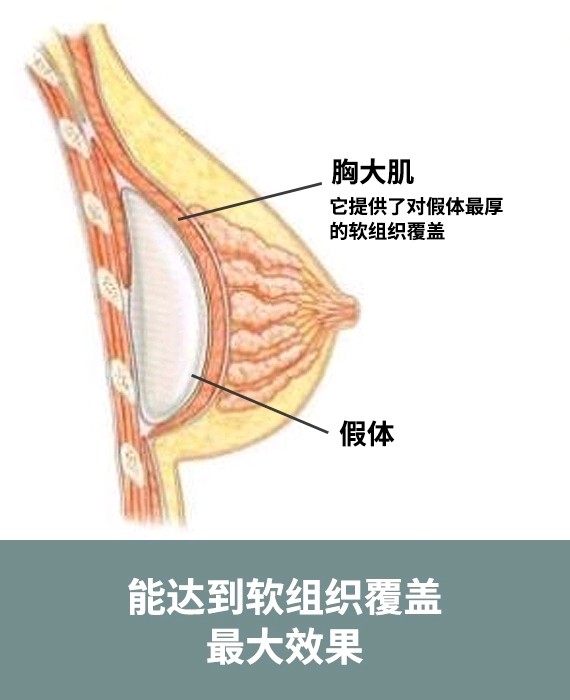 胸大肌及其筋膜的下方,并且在乳房下皱襞区域保留整个胸大肌起点