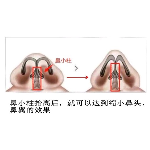 昱哥每日科普——耳软骨做鼻尖会塌陷鼻头整形究竟什么材料是最理想的