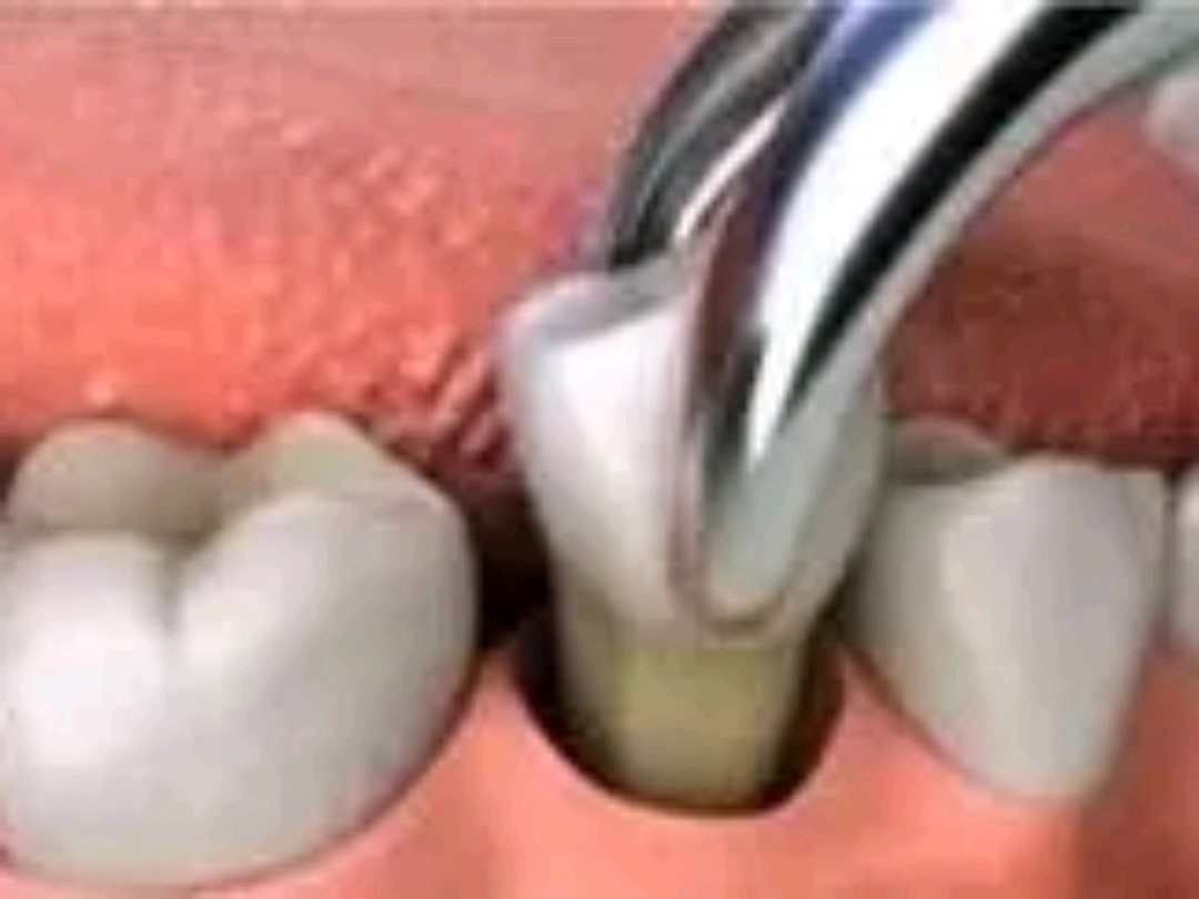 拔牙后多久可以种植牙齿?