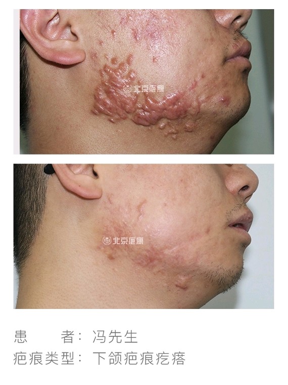 北京疤康下颌疤痕疙瘩病例分享