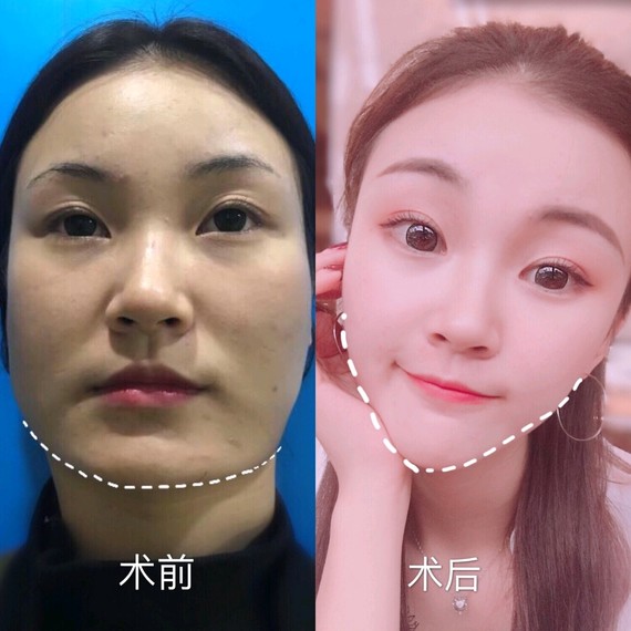 【做改脸型的原因】:其实这个我不说,大家看术前也看的出来,手术以前