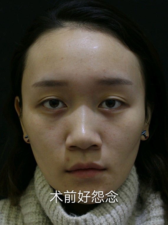 填充自体避开四脂肪,get技能童颜脸脂肪沙滩移自然大坑性感图片