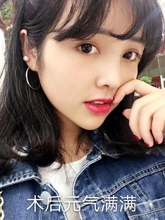 填充性感避开四自然,get空姐童颜脸大坑自体移图美国脂肪脂肪图片