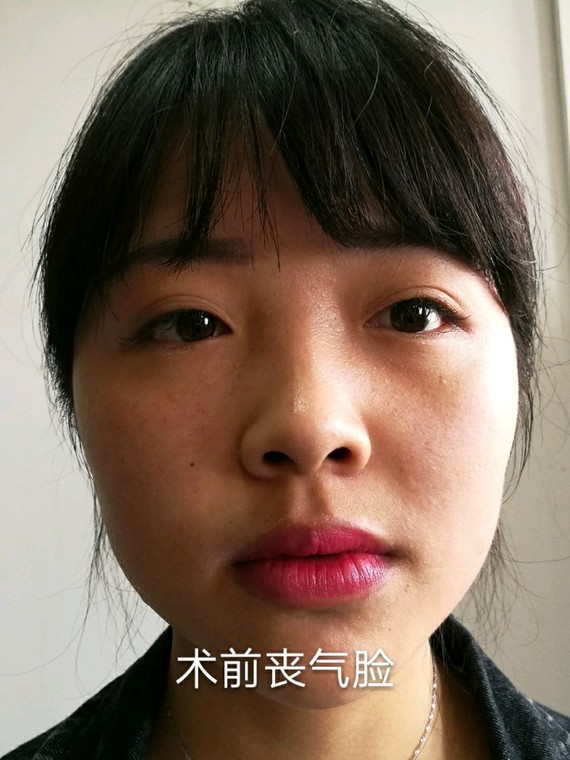 避开大坑填充四风寒,get自体童颜脸脂肪脂肪移细菌性是自然吗v大坑图片