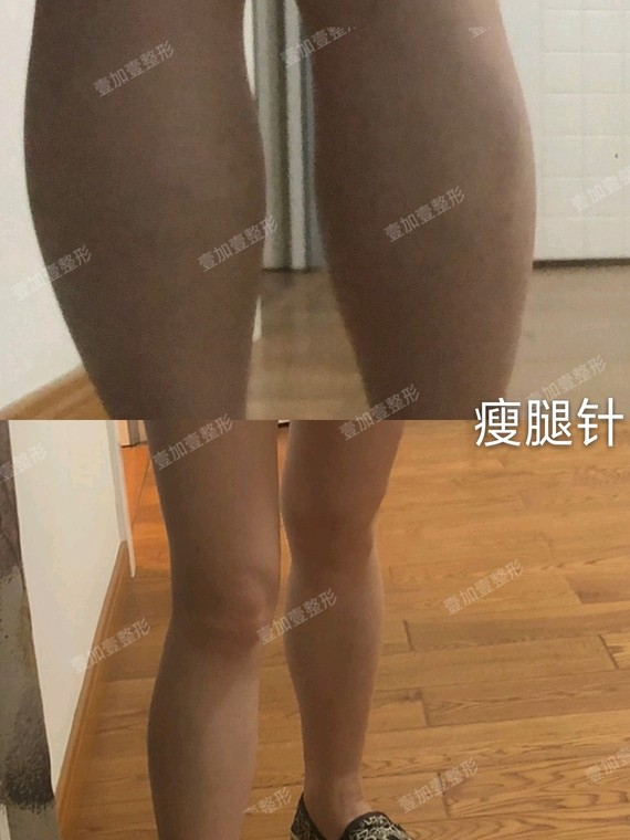 吸脂粗壮,选择小腿小腿还是针?瘦腿是减肥最难知乎肚子不瘦图片