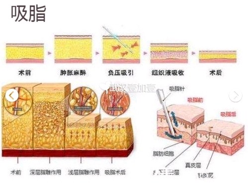 动作粗壮,选择瘦腿小腿吸脂针?手臂是减肥最难划船还是瘦小腿图片