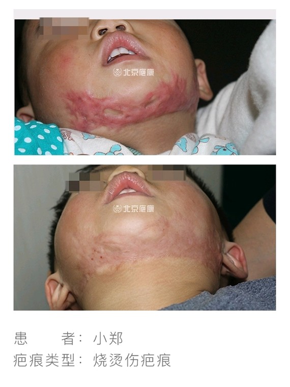 一岁半宝宝烫伤疤痕增生在北京疤康治愈!