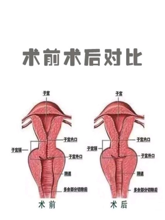 激光之后更加权威高端私处抗衰缩阴仪器,该技术无出血,无开刀,无疤痕