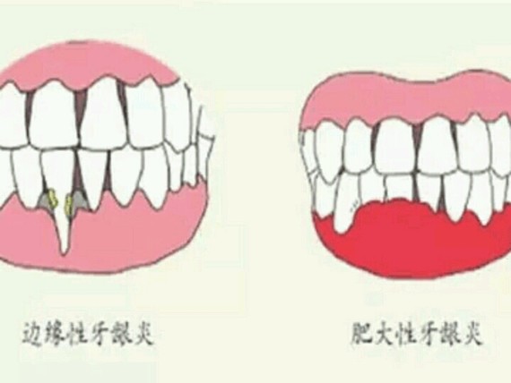 牙龈炎有哪些症状