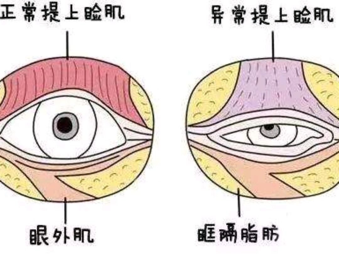 【上睑提肌】是指利用外科手术,将不同程度,不能发挥正常功能的上睑提