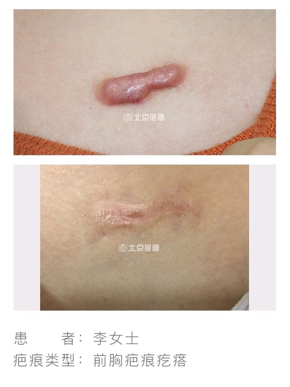 胸前疤痕疙瘩怎么去除?北京疤康非手术综合治疗,承诺瘢痕治愈不复发!