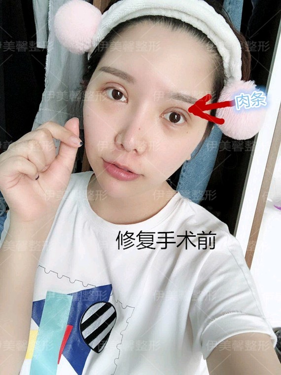 埋线双眼皮