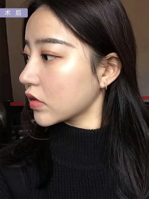姑娘的91的高点比较靠上,有点驼峰鼻,当时给她推