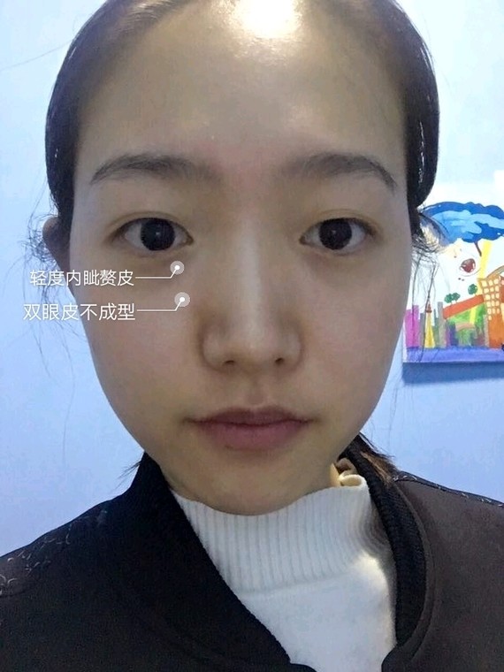 为什么做双眼皮都建议开眼角?