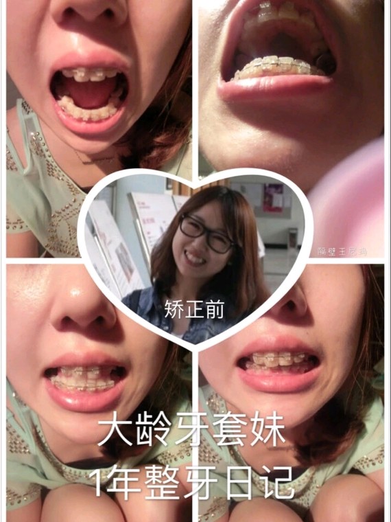 接着我的姐姐和朋友陆续的进行了牙齿矫正,目前她们也都已经摘了牙套