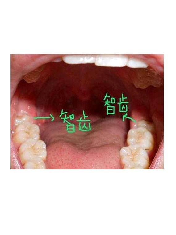 智齿,就是我们俗称的大牙,是长在嘴边上下左右最靠近喉咙的臼齿,并
