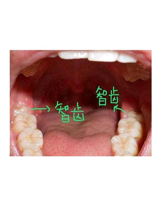 智齿对于我们来说可有可无,不影响咀嚼,但是如果智齿生长的方向不正
