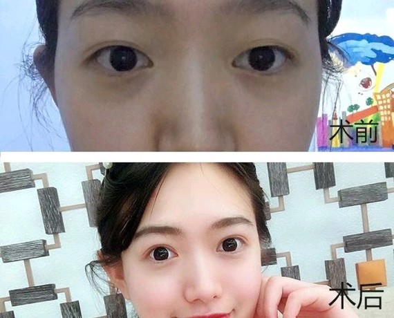 内双的眼睛是否可以做双眼皮呢?9595想必很多宝宝