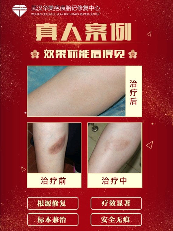 科普| 如何判断自己是不是疤痕体质?