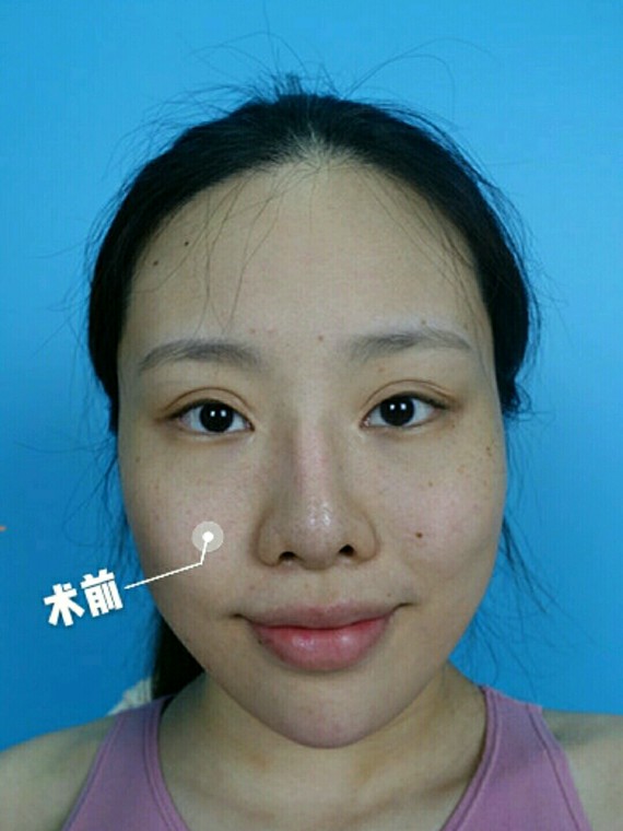面部凹陷下垂,填充和埋线怎么选?