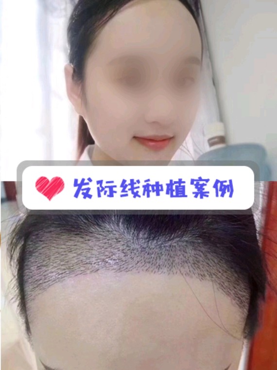 种植发际线