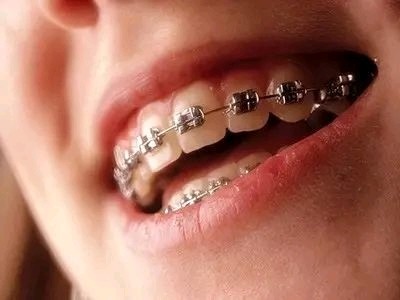 35岁还可以做牙齿矫正吗?牙齿矫正分为哪几种