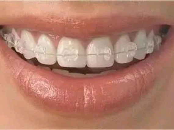 35岁还可以做牙齿矫正吗?牙齿矫正分为哪几种