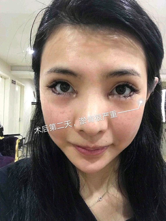 想开眼角?到院步骤提前知很多小仙女想改善眼