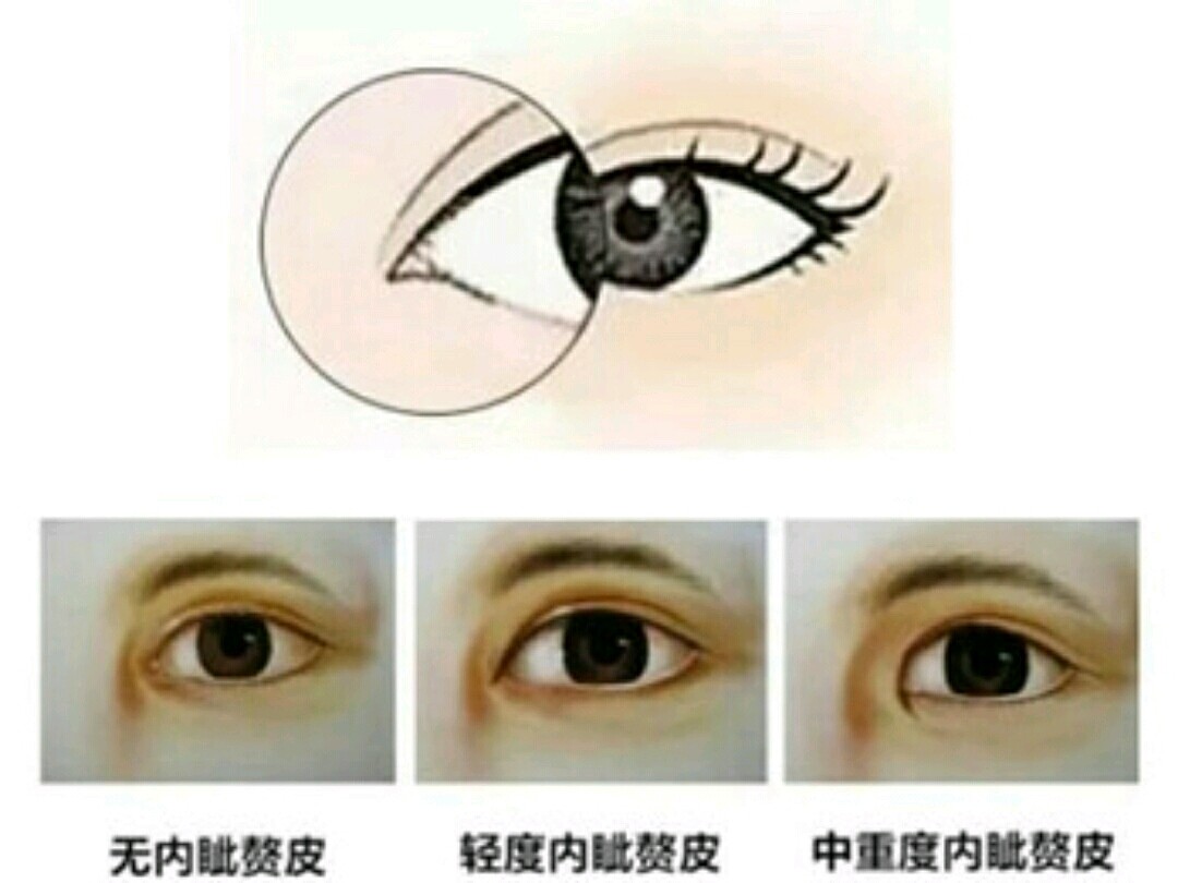 双眼皮也能解决内眦赘皮两眼无神