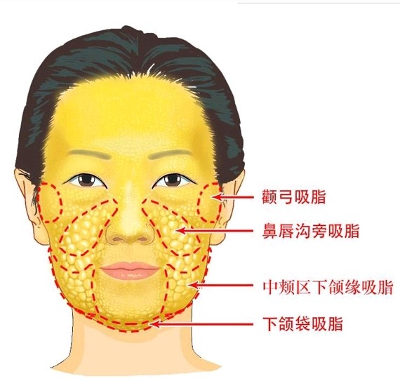 面部吸脂分几个部位不管怎么说,一张浮肿的大饼脸,不是亲们想要的,不