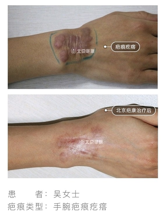 身上多处长有疤痕疙瘩在北京疤康治疗康复!来