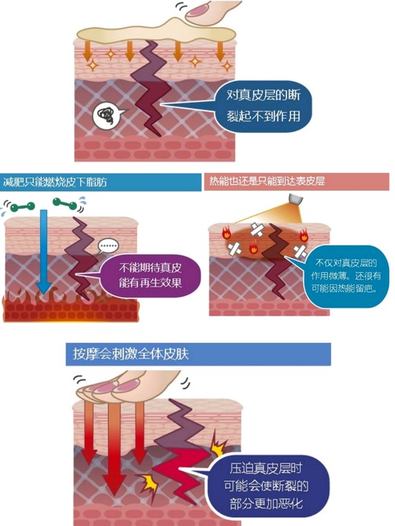 生长过快或体重骤增的过程中产生的皮肤纤维断裂现象