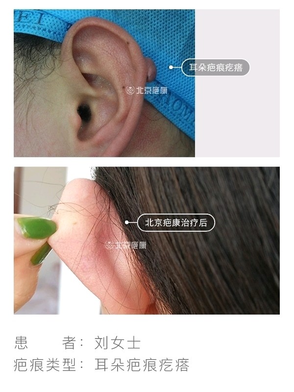 打耳洞长了疤痕疙瘩怎么办?北京疤康综合防治,承诺瘢痕治愈不复发!